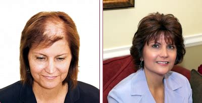 Rhode island women hair loss  View Details